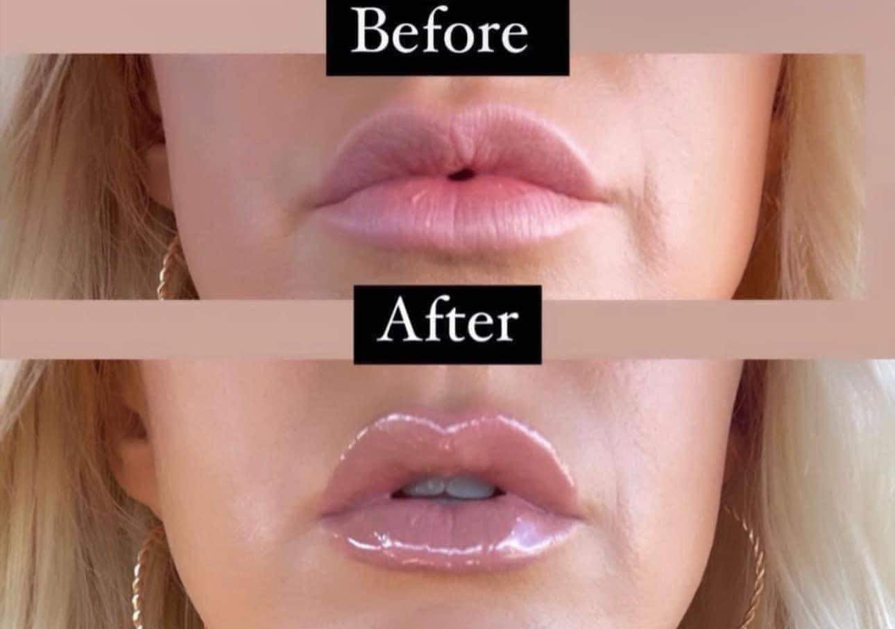 Peptide Lip Plump