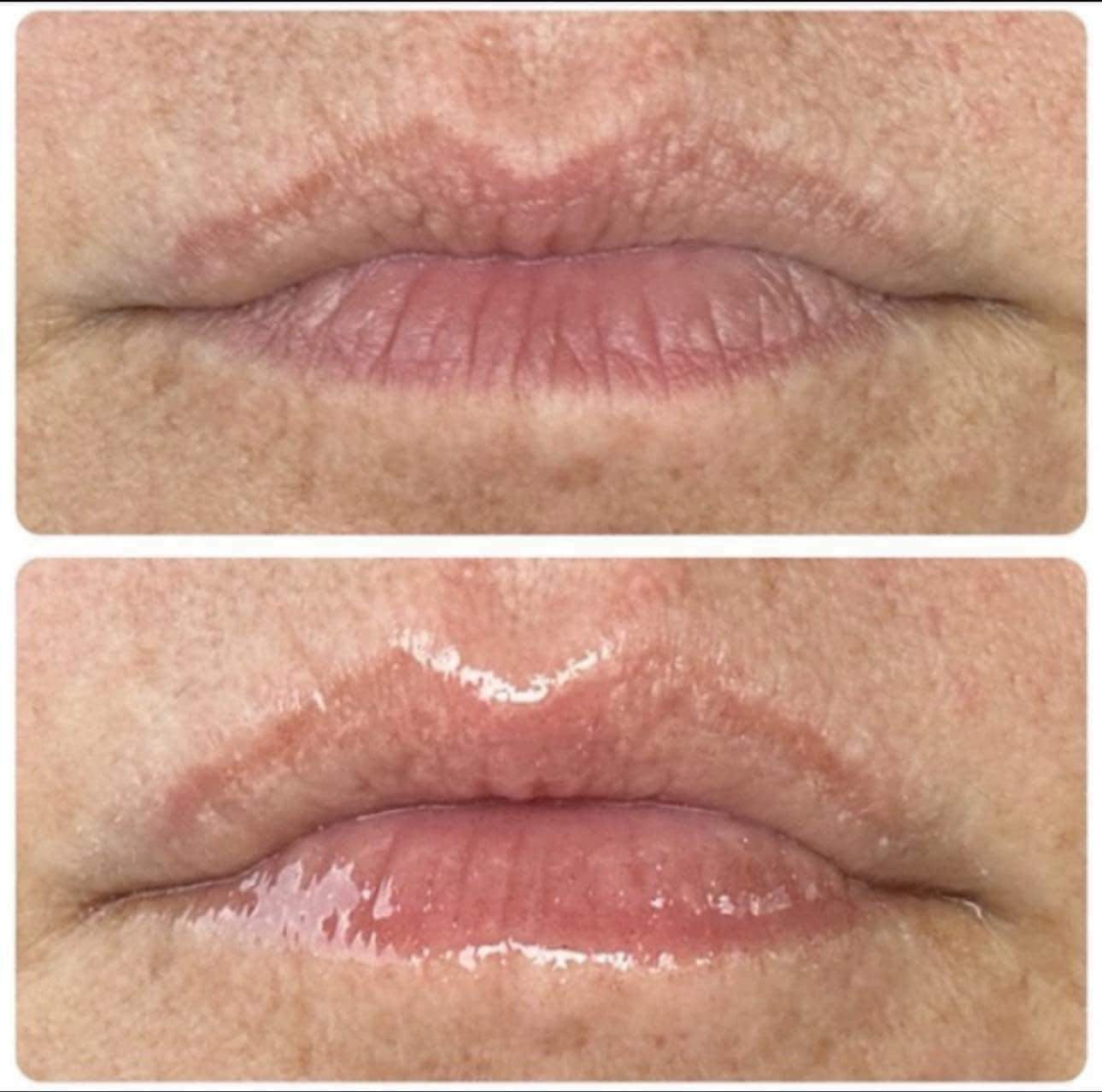 Peptide Lip Plump